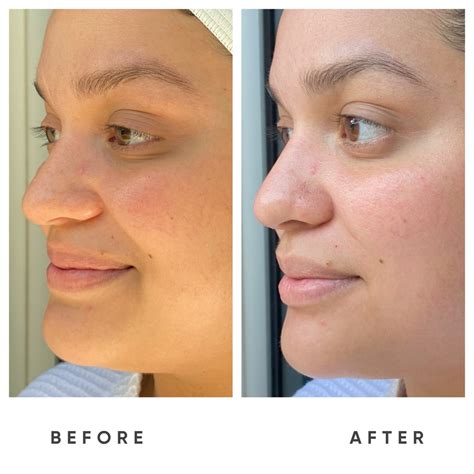 ZEMITS DermeLuxx | Esthetic Spa Equipment for sale