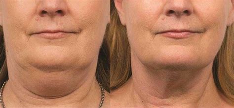 Celebrity Double Chin Surgery 60 Photos - Moonagedaydream.film