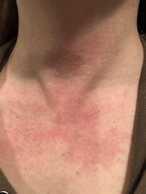 Fungal Rash On Neck