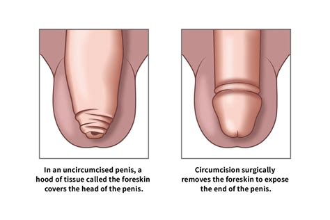 Full Circumcision