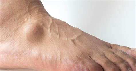 Foot & Ankle Cysts | Types, Causes, and Treatments | CLS Health