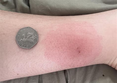 mosquito bite keeps getting bigger, starting to blister : r/medical_advice