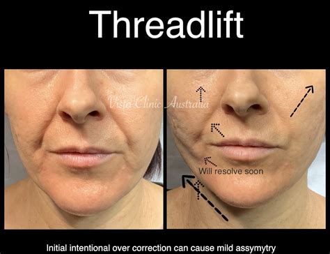PDO thread lift - Vista Clinic Melbourne Australia