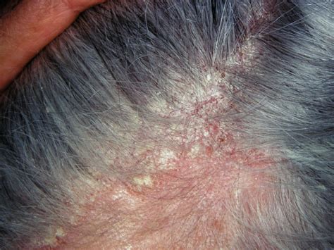 seborrheic dermatitis 意味 – 脂漏性皮膚炎 治療方法 – ZEAPST