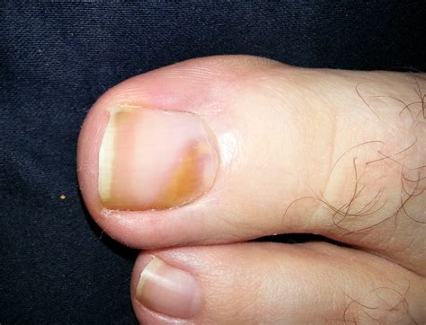Why Are My Toe Nails Turning Black - Design Talk