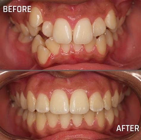 Braces For Crowded Teeth Before And After at Isaac Macquarie blog