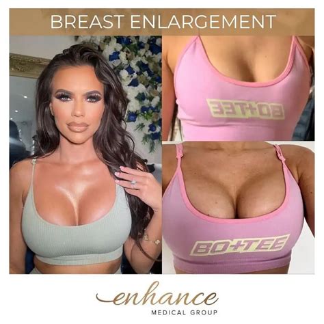 E Breast Implants