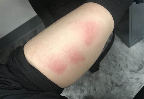 Do Tiny Carpet Beetles Bite at Blake Lavater blog