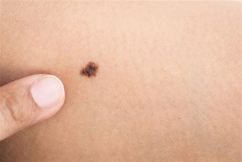 Pictures of cancerous moles: early stage, cancerous moles images ...