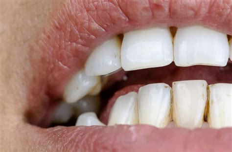 Does Vaping Stain Your Teeth? | Ancaster