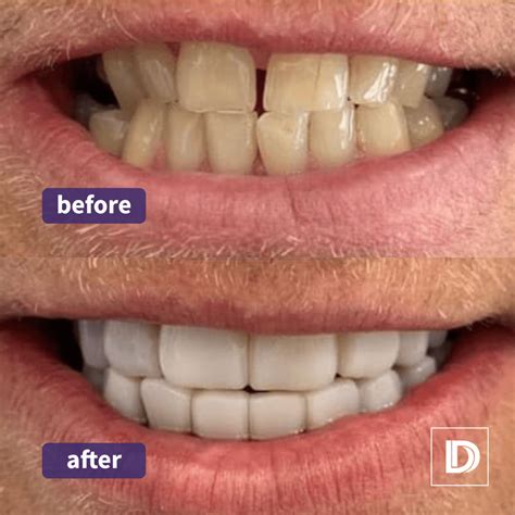Composite Edge Bonding Cost Per Tooth at Tammy Teel blog