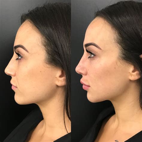 Cheek Filler Brisbane | Cheek Dermal Fillers and Biostimulator Injections