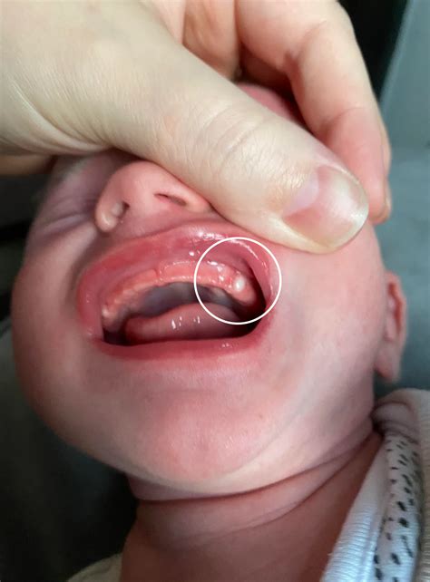 Epstein Pearls in Babies: Causes, Symptoms & Safe Treatment