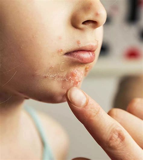 Causes & Signs Of Hand, Foot, And Mouth Disease In Pregnancy