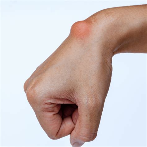 All You Need to Know About Treating Ganglion Cysts: A Comprehensive Guide - Dr. Colin Hong