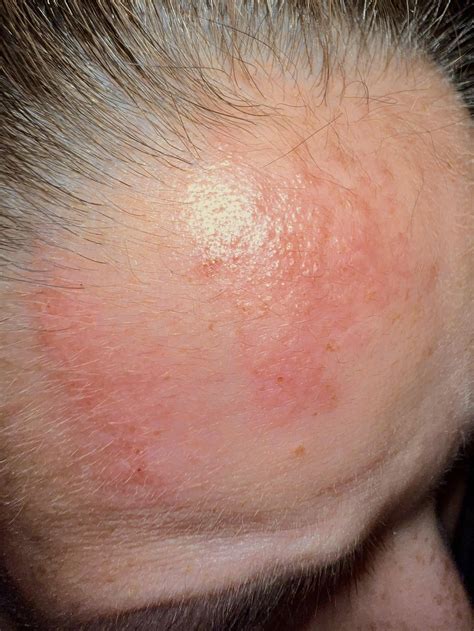 Itching Rash On Chin at Thomas Reiser blog