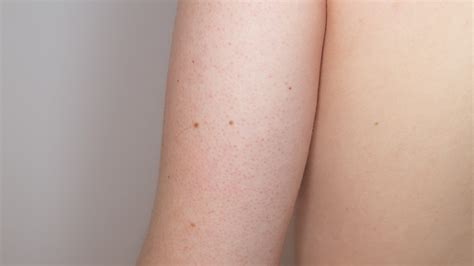 Keratosis Pilaris: Diagnosis, Causes, & Treatment - Toronto Dermatology Centre