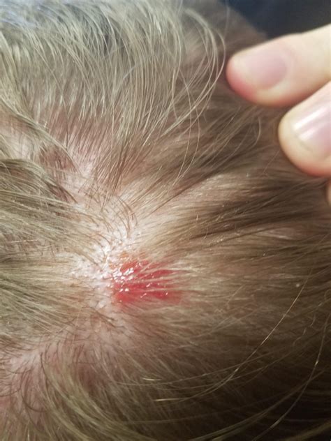 Itchy bump on scalp after being in the woods. Doesn't seem to be a tick bite, though. Any ideas ...