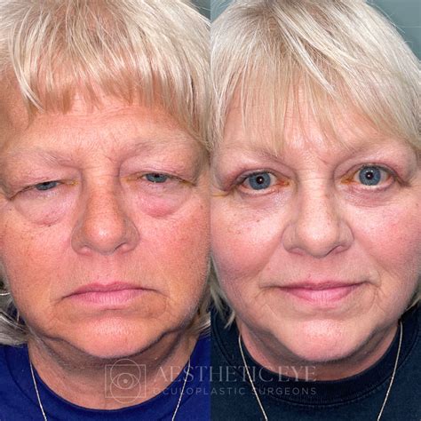 Cincinnati OH Forehead/Brow Lift Surgery | Dayton Endoscopic Browlift