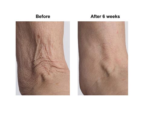 Protein For Crepey Skin | How To Get Rid Of Crepey Skin