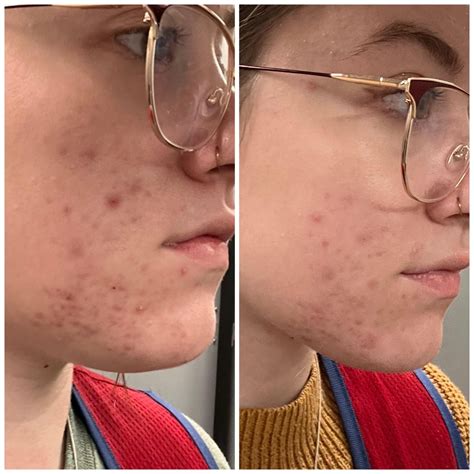 [B&A] super impressed with the results I’ve seen with Hero Cosmetics’ lighting wand after only ...