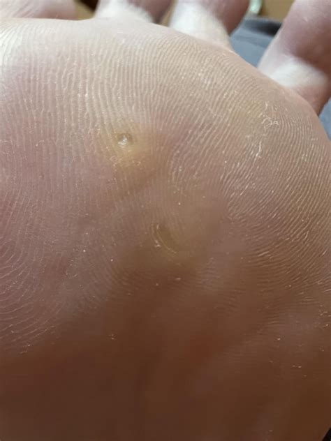 Seed corn or plantar wart? : r/Warts