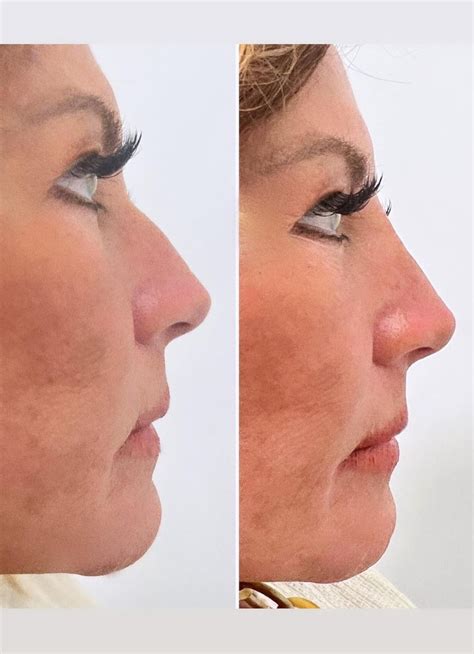 Abby Lee Miller Shows Off Her Liquid Nose Job