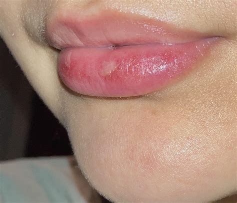 Is this a canker sore? I picked my lips really bad to the point where ...
