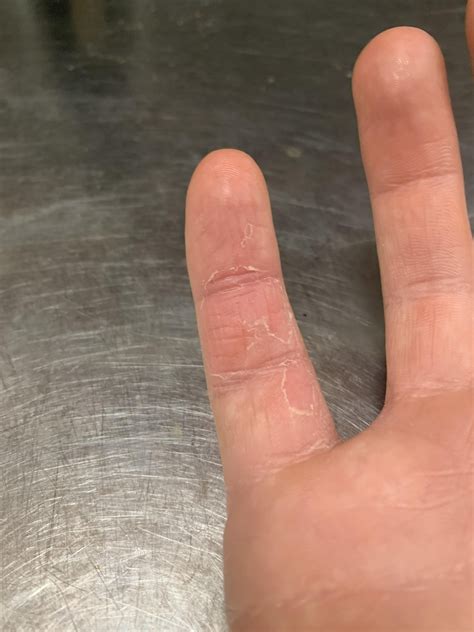 For those wondering how much a centipede sting hurts: here you go : r/centipedes