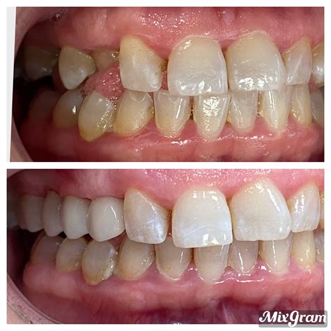 Before & After - Skyline Smiles