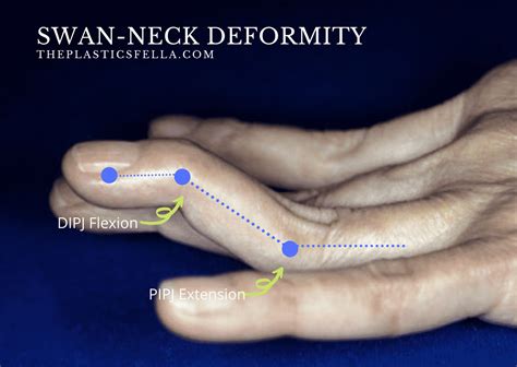 Swan Neck Deformity vs Boutonnières