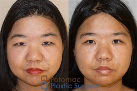 Facial Plastic Surgeon in Washington, DC, & Arlington, VA | About Us | Potomac Plastic Surgery®