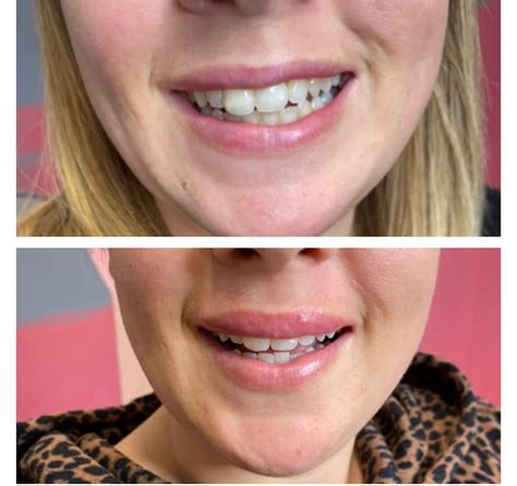 Lip-Flip Treatment - MicosmeticsUK - Essex Aesthetics