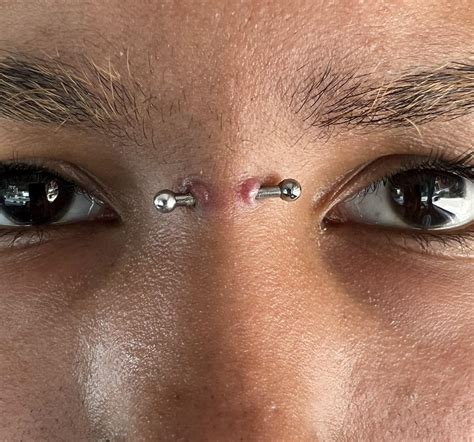 1.75 year old bridge still getting irritation bumps : r/piercing