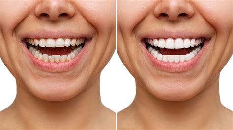 What Are Veneers? | Granite Belt Dental