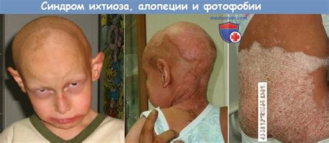 Синдром фолликулярного ихтиоза, аллопеции и фотофобии - причины ...