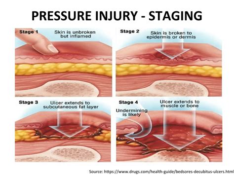Pressure Injury | PPT