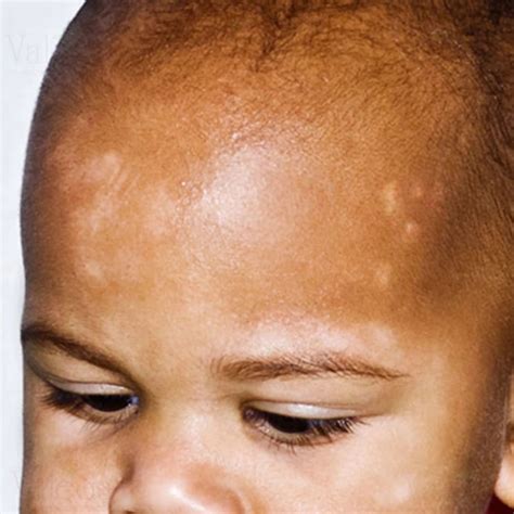 Pityriasis Alba Care: Causes, Symptoms & Skin Solutions | Valeda the World of Holistic Wellness