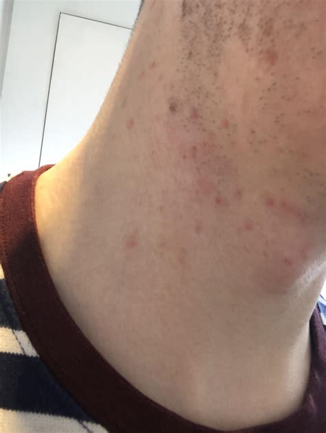 [Acne] I have these red marks on my neck that fluctuate in redness, sometimes they’re quite red ...