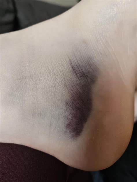 Blood pooling in foot from knee injury? : r/medical
