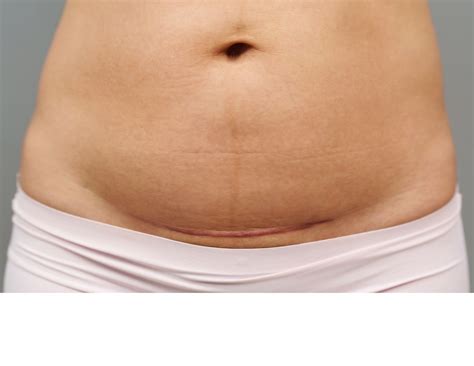 Step-by-step Guide to C-section Scar Massage Using Cups — Healthy Mumma ...