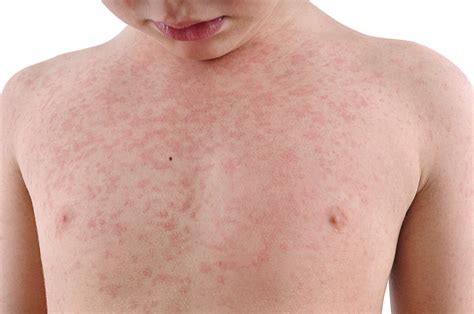 Alergias de piel ¿Cuáles son las más comunes y cómo prevenirlas?