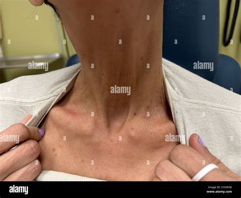 Rash on the neck of a patient with lymphoma. Lymphomas are blood cancers that affect white blood ...