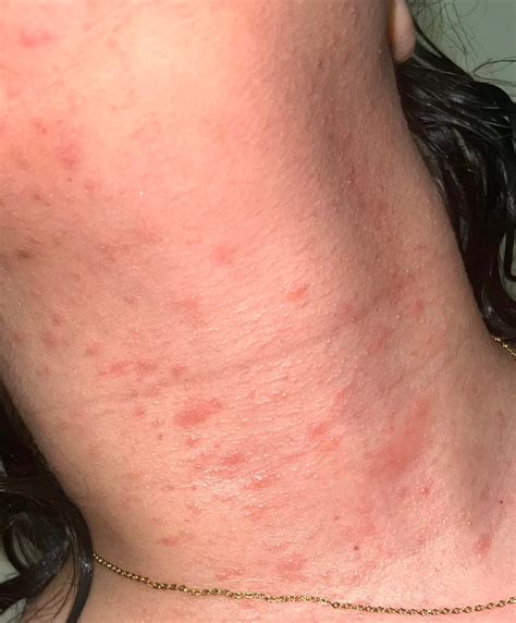Sudden rash on face and neck : r/DermatologyQuestions