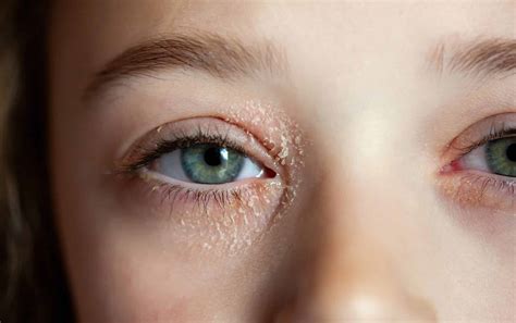 Eyelid Dermatitis vs Eczema: - Bragan Skincare