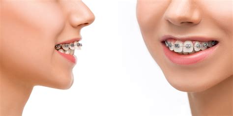 Braces For Overbite Teeth at Gidget Byrd blog