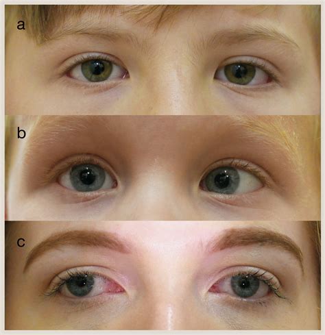 Assessing strabismus in children - Paediatrics and Child Health