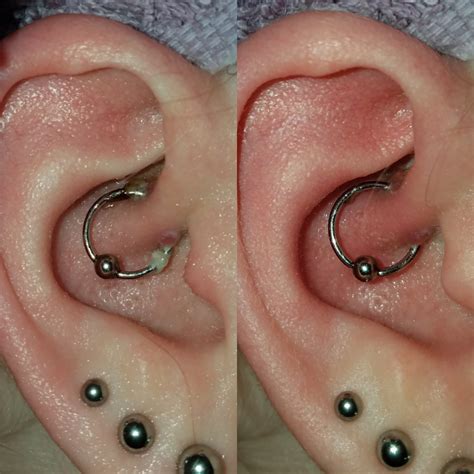 How To Get Rid Of Keloids On Ear Without Surgery at Pauline Smith blog