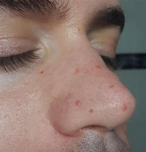 What Do Little Red Bumps On Face Mean