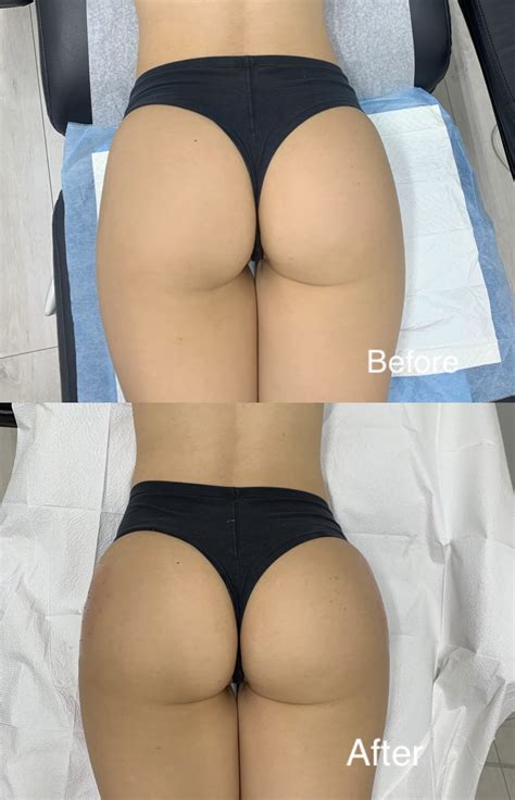 Sculptra® Butt Lift Toronto | Non-Surgical BBL Mississauga | Skinatomy